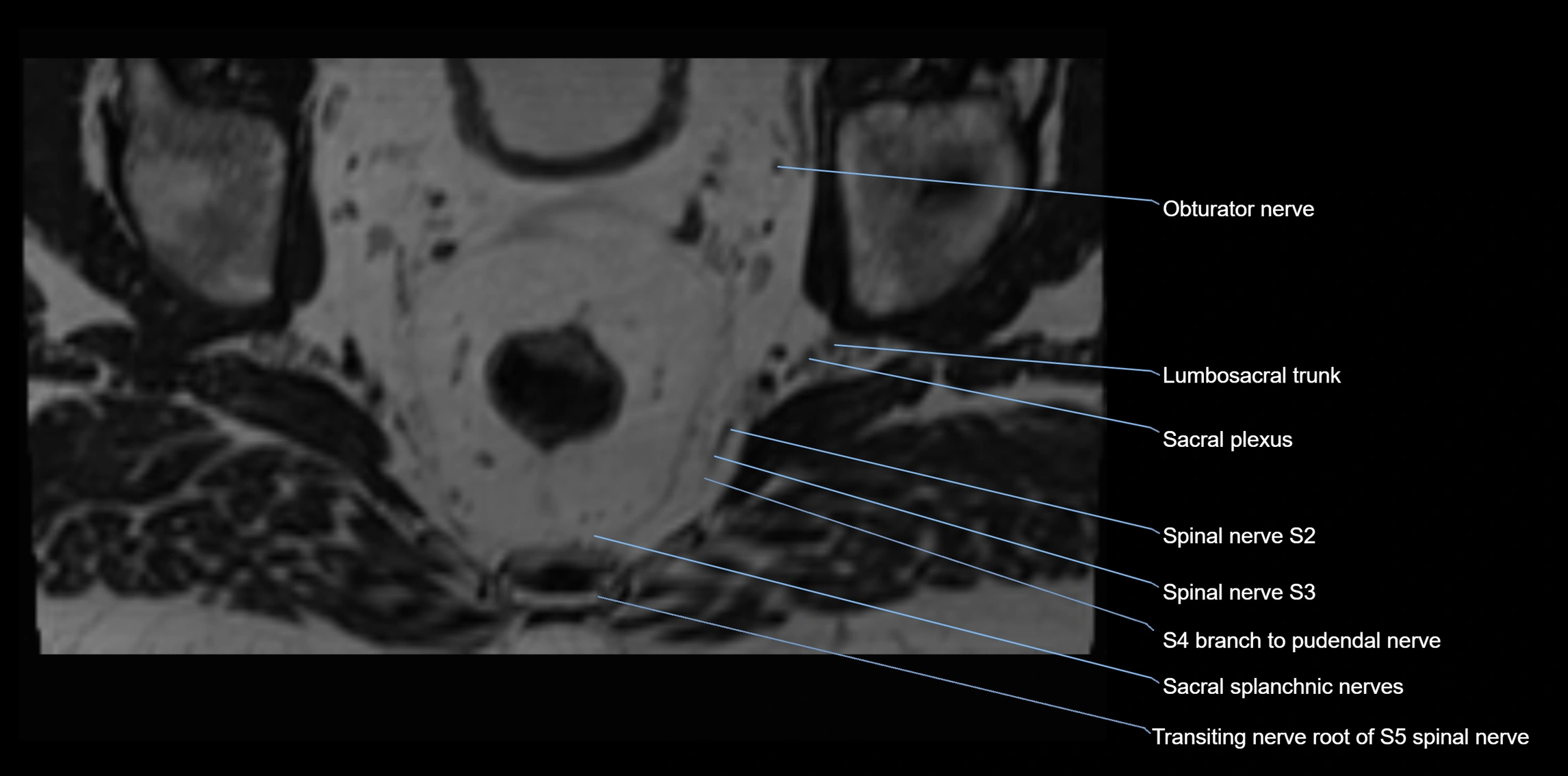 MR lumbosacral plexus axial cross sectional anatomy 3T  radiology  image-img-1008001-00107.webp